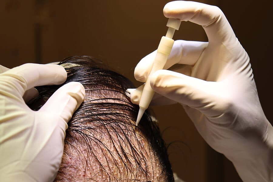 Hair Transplant Istanbul with Natural Results Guaranteed Approach